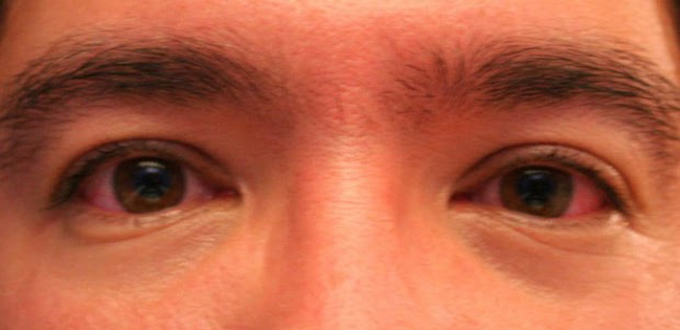 Konjungtivitis atau Mata Merah