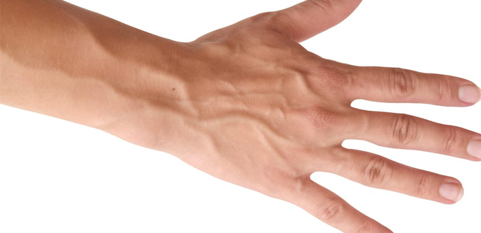 Penyebab Urat Menonjol